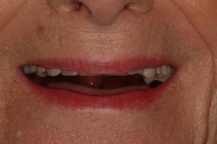 denture - before denture - before