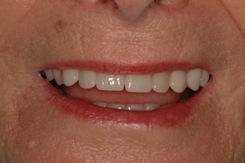 denture - after denture - after