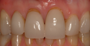 These veneers were done by Dr Shepperson in 1989. They are now 29 years old, with some gum recession which is not visible in the smile.