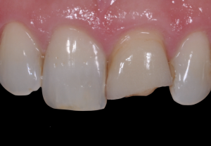 Broken veneer