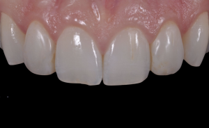 11 year old composite resin veneers.
