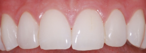 Composite laterals 4 years