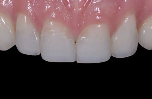 Composite resin 10 years pitting