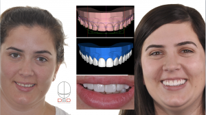 Digital Smile Design + Veneers