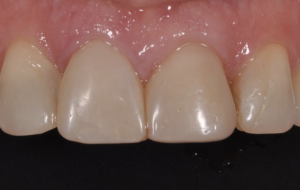 Older composite veneers