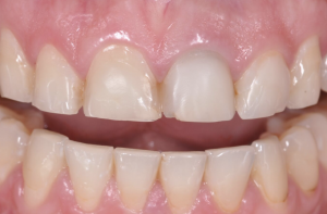 Masking a grey tooth.