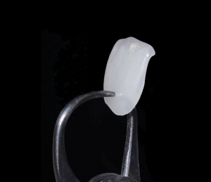 Veneers are very thin: between 0.3-0.7mm