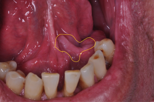 Oral cancer visible in the mouth