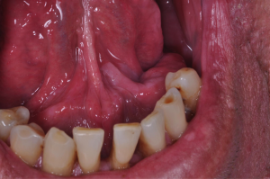 Oral cancer in the mouth
